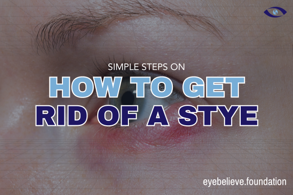 How To Get Rid Of A Stye and Prevent Them